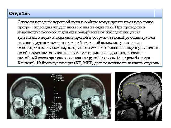 Опухоль Опухоли передней черепной ямки и орбиты могут проявляться неуклонно прогрессирующим ухудшением зрения на