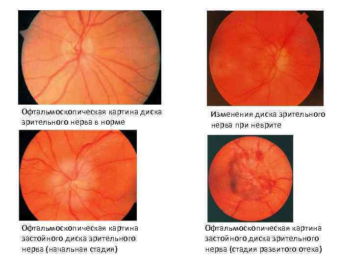 Офтальмоскопическая картина диска зрительного нерва в норме Офтальмоскопическая картина застойного диска зрительного нерва (начальная