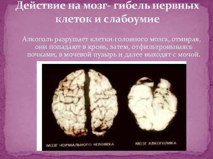 Действие на мозг- гибель нервных клеток и слабоумие Алкоголь разрушает клетки головного мозга, отмирая,