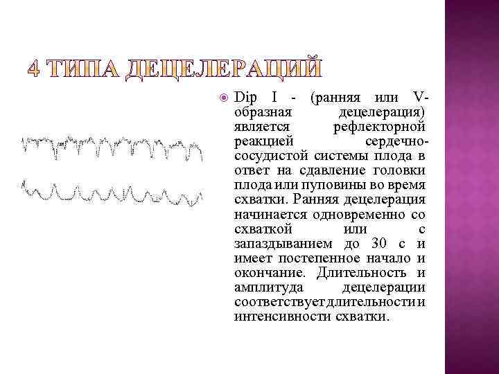  Dip I (ранняя или V образная децелерация) является рефлекторной реакцией сердечно сосудистой системы