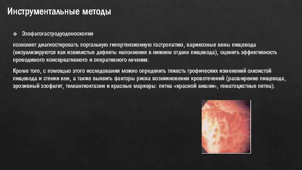 Инструментальные методы Эзофагогастродуоденоскопия позволяет диагностировать портальную гипертензионную гастропатию, варикозные вены пищевода (визуализируются как извилистые