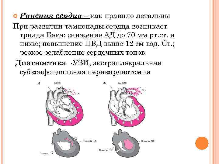 Ранения сердца – как правило летальны При развитии тампонады сердца возникает триада Бека: снижение