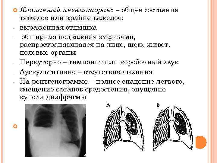 Клапанный пневмоторакс. Клинические проявления клапанного пневмоторакса. Симптомы характерные для пневмоторакса. Клапанный пневмоторакс клиническая картина. Клапанный пневмоторакс пневмоторакс.