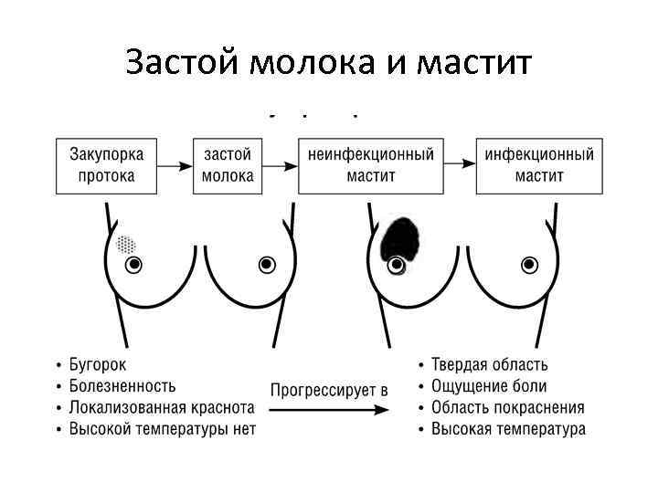 Застой молока и мастит 