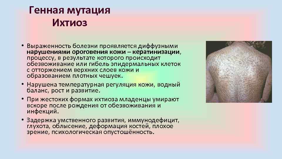 Генная мутация Ихтиоз • Выраженность болезни проявляется диффузными нарушениями ороговения кожи – кератинизации, процессу,