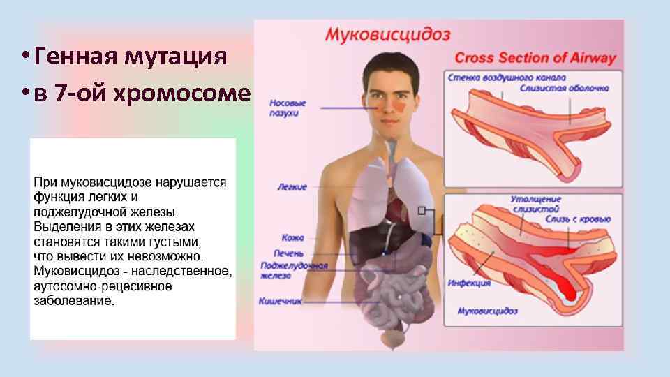  • Генная мутация • в 7 -ой хромосоме 