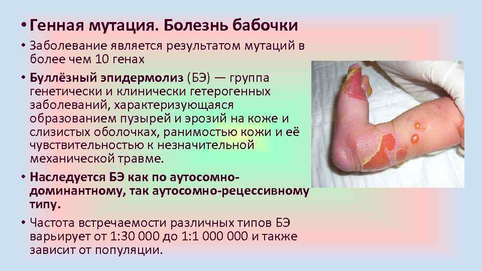  • Генная мутация. Болезнь бабочки • Заболевание является результатом мутаций в более чем