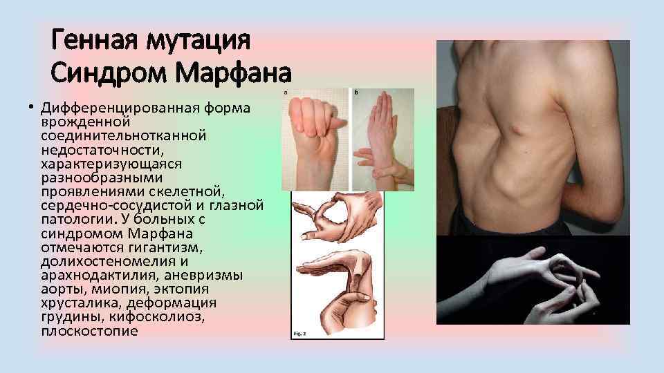 Генная мутация Синдром Марфана • Дифференцированная форма врожденной соединительнотканной недостаточности, характеризующаяся разнообразными проявлениями скелетной,