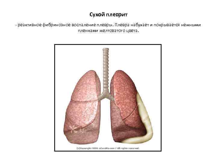Сухой плеврит - реактивное фибринозное воспаление плевры. Плевра набухает и покрывается нежными пленками желтоватого