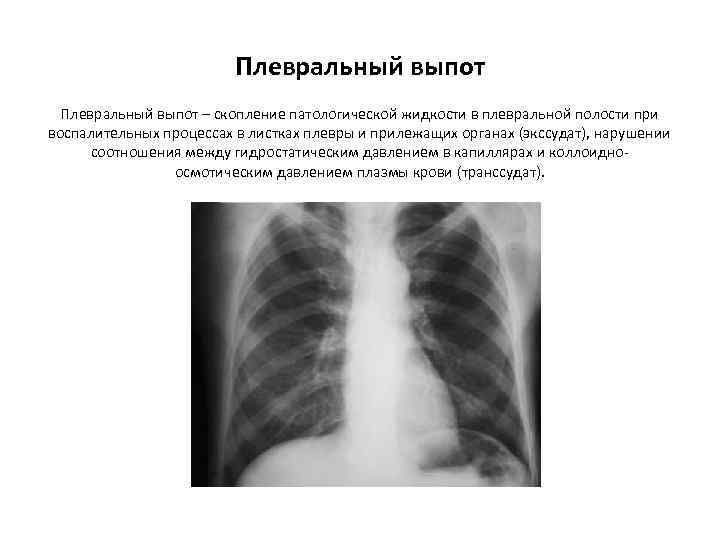 Плевральный выпот – скопление патологической жидкости в плевральной полости при воспалительных процессах в листках