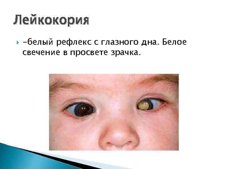 Лейкокория -белый рефлекс с глазного дна. Белое свечение в просвете зрачка. 