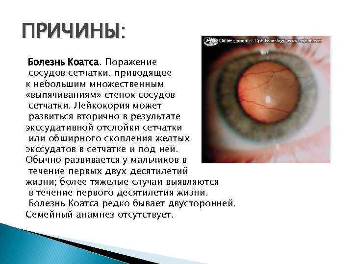 ПРИЧИНЫ: Болезнь Коатса. Поражение сосудов сетчатки, приводящее к небольшим множественным «выпячиваниям» стенок сосудов сетчатки.