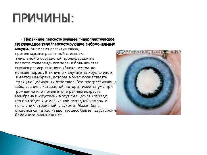 ПРИЧИНЫ: • Первичное персистирующее гиперпластическое стекловидное тело/персистирующие эмбриональные сосуды. Аномалия развития глаза, проявляющаяся различной