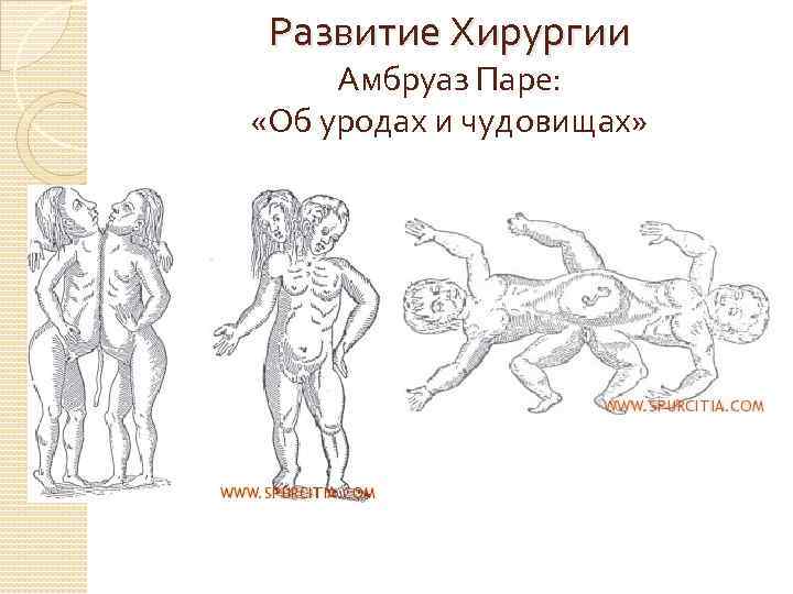Развитие Хирургии Амбруаз Паре: «Об уродах и чудовищах» 