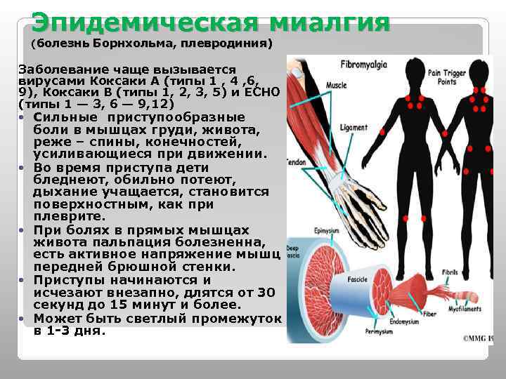 Эпидемическая миалгия (болезнь Борнхольма, плевродиния) Заболевание чаще вызывается вирусами Коксаки А (типы 1 ,