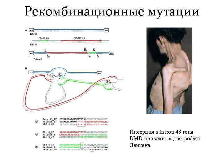Рекомбинационные мутации Инсерция в intron 43 гена DMD приводит к дистрофии Дюшена 