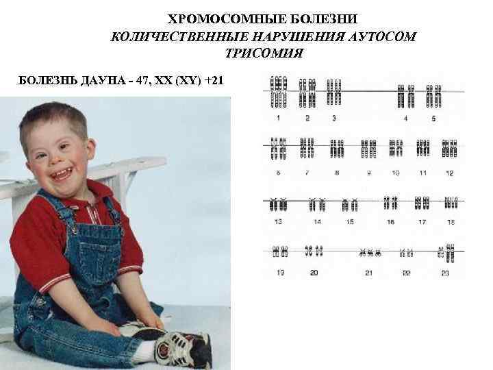 Сколько хромосом у людей с синдромом дауна