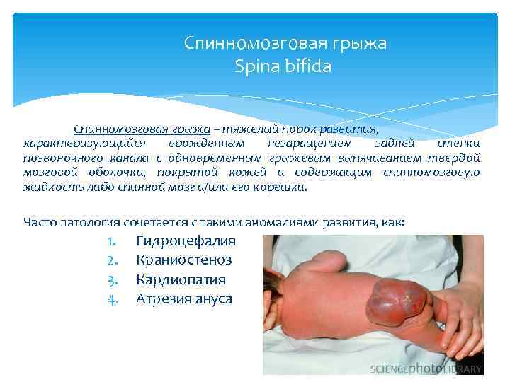 Спинномозговая грыжа Spina bifida Спинномозговая грыжа – тяжелый порок развития, характеризующийся врожденным незаращением задней