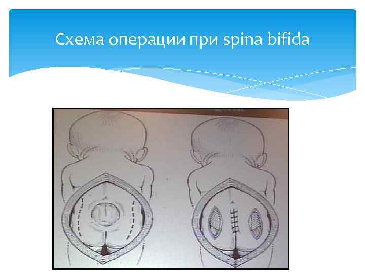 Схема операции при spina bifida 