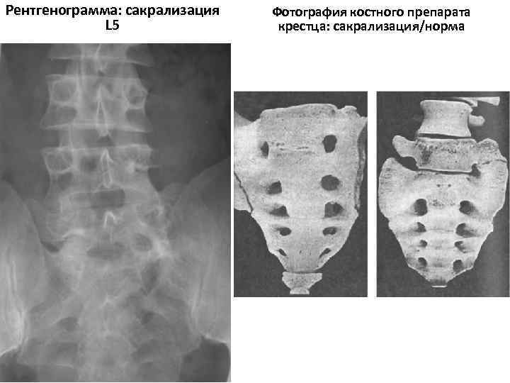 Рентгенограмма: сакрализация L 5 Фотография костного препарата крестца: сакрализация/норма 