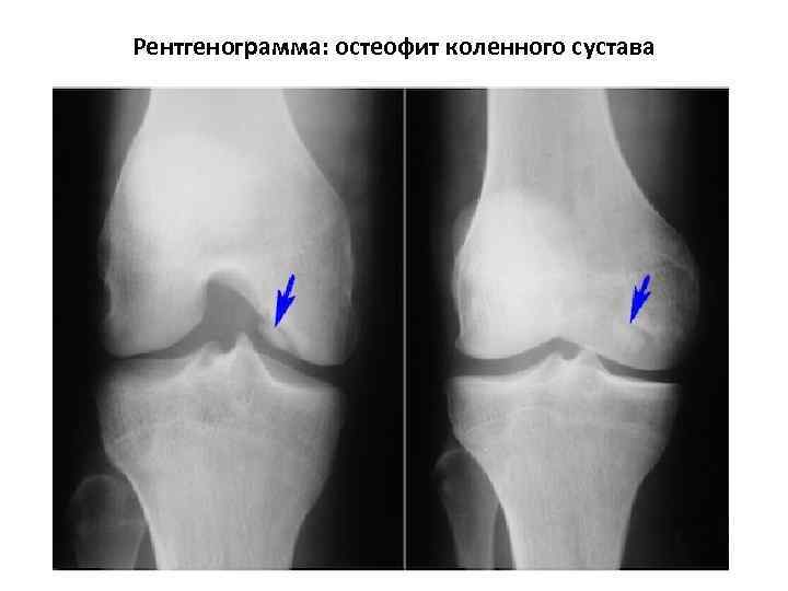 Рентгенограмма: остеофит коленного сустава 