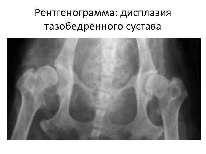 Рентгенограмма: дисплазия тазобедренного сустава 