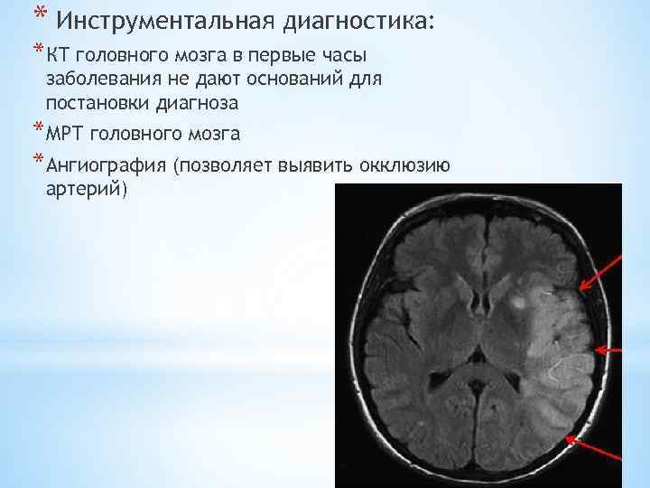 * Инструментальная диагностика: *КТ головного мозга в первые часы заболевания не дают оснований для