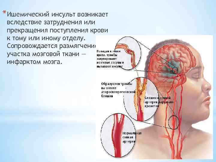 Ишемический инсульт 2023. Ишемический инсульт головного мозга. Ишемическом мозговом инсульте.