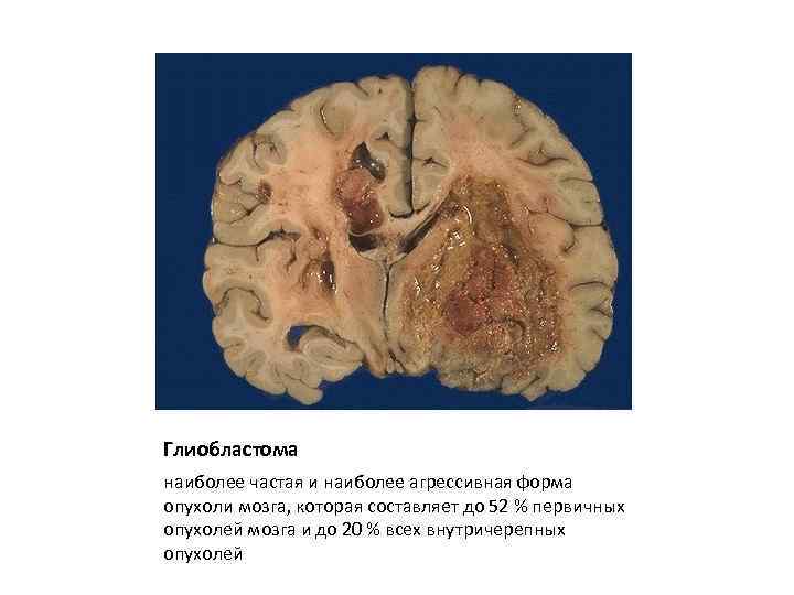 Глиобластома наиболее частая и наиболее агрессивная форма опухоли мозга, которая составляет до 52 %