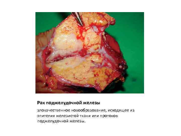 Рак поджелудочной железы злокачественное новообразование, исходящее из эпителия железистой ткани или протоков поджелудочной железы.