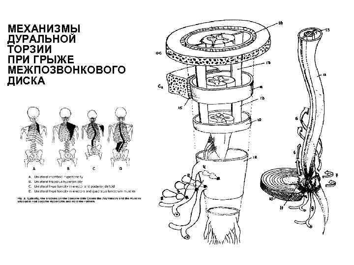 МЕХАНИЗМЫ ДУРАЛЬНОЙ ТОРЗИИ ПРИ ГРЫЖЕ МЕЖПОЗВОНКОВОГО ДИСКА 