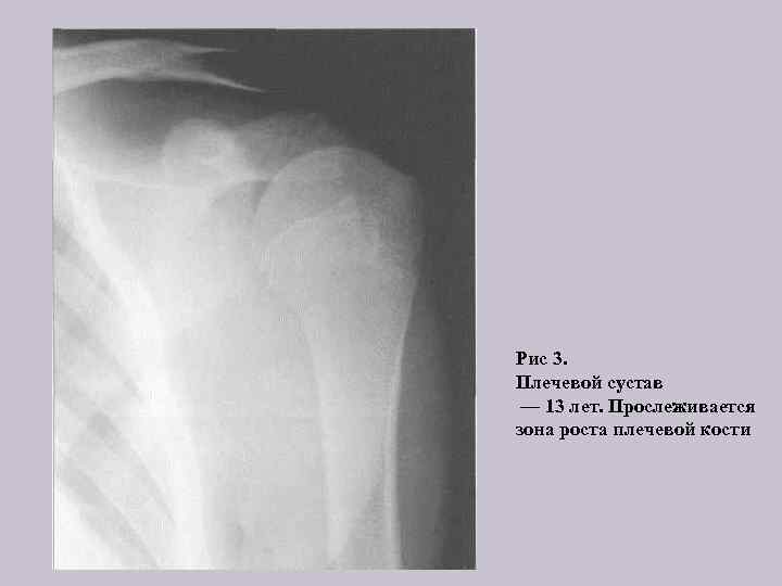 Рис 3. Плечевой сустав — 13 лет. Прослеживается зона роста плечевой кости 