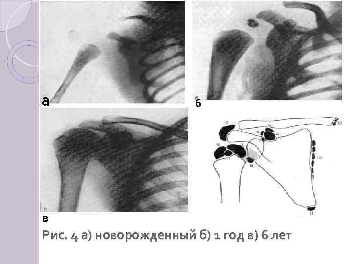 а б в Рис. 4 а) новорожденный б) 1 год в) 6 лет 