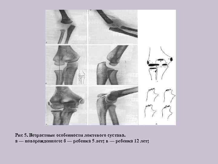 Рис 5. Возрастные особенности локтевого сустава. а — новорожденного: б — ребенка 5 лет;