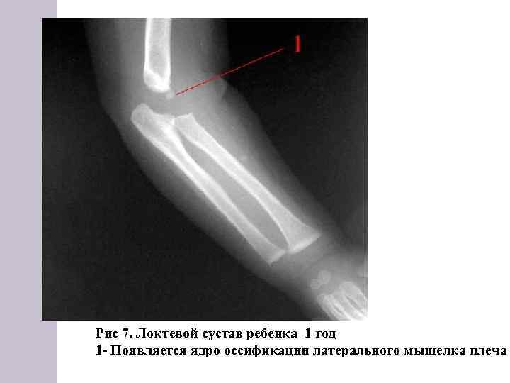 Рис 7. Локтевой сустав ребенка 1 год 1 Появляется ядро оссификации латерального мыщелка плеча