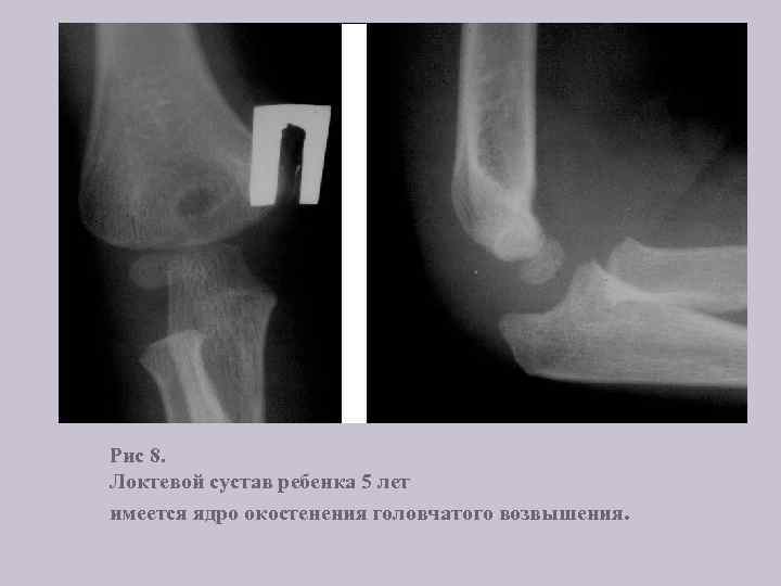 Рис 8. Локтевой сустав ребенка 5 лет имеется ядро окостенения головчатого возвышения. 