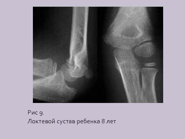 Рис 9. Локтевой сустав ребенка 8 лет 