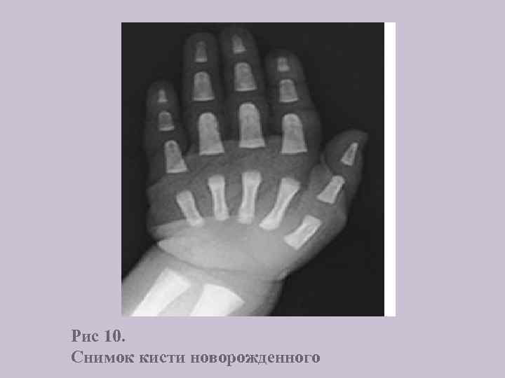 Рис 10. Снимок кисти новорожденного 