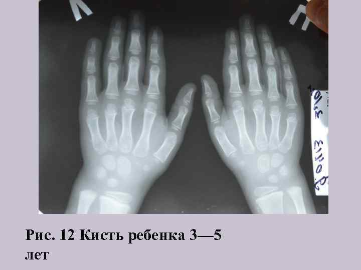 Рис. 12 Кисть ребенка 3— 5 лет 