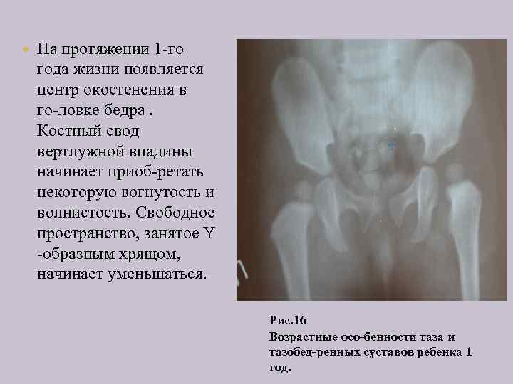 Окостенение головки бедренной кости