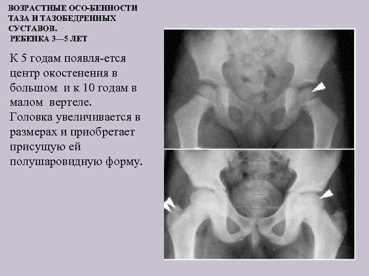 ВОЗРАСТНЫЕ ОСО БЕННОСТИ ТАЗА И ТАЗОБЕДРЕННЫХ СУСТАВОВ. РЕБЕНКА 3— 5 ЛЕТ К 5 годам