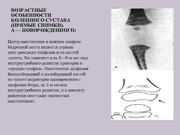 ВОЗРАСТНЫЕ ОСОБЕННОСТИ КОЛЕННОГО СУСТАВА (ПРЯМЫЕ СНИМКИ). А — НОВОРОЖДЕННОГО; Центр окостенения в нижнем эпифизе