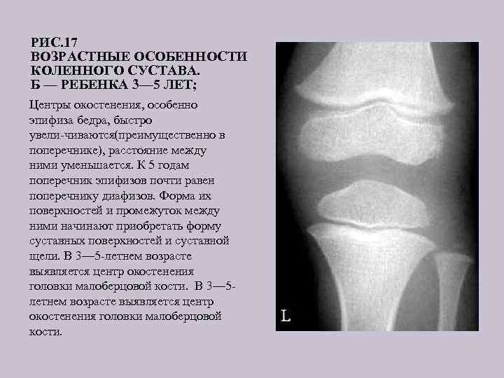 РИС. 17 ВОЗРАСТНЫЕ ОСОБЕННОСТИ КОЛЕННОГО СУСТАВА. Б — РЕБЕНКА 3— 5 ЛЕТ; Центры окостенения,