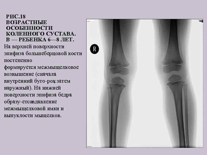 РИС. 18 ВОЗРАСТНЫЕ ОСОБЕННОСТИ КОЛЕННОГО СУСТАВА. В — РЕБЕНКА 6— 8 ЛЕТ. На верхней