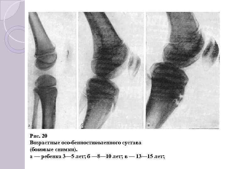 Рис. 20 Возрастные осо бенностиколенного сустава (боковые снимки). а — ребенка 3— 5 лет;