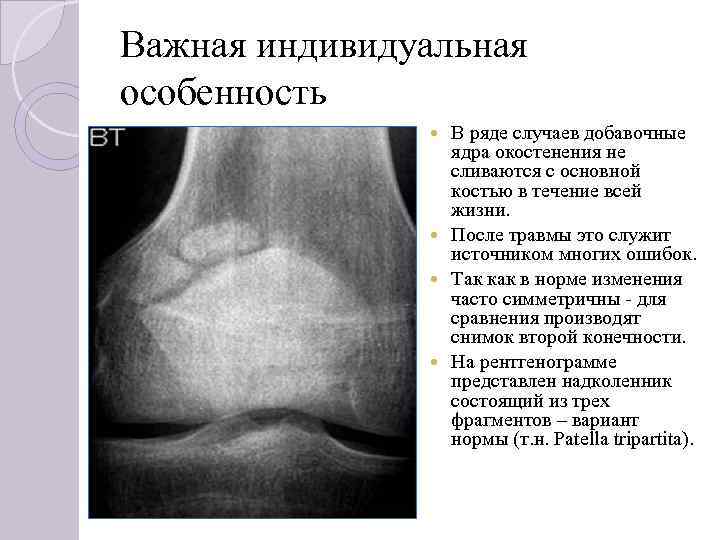 Важная индивидуальная особенность В ряде случаев добавочные ядра окостенения не сливаются с основной костью