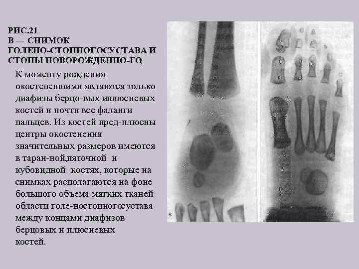 РИС. 21 В — СНИМОК ГОЛЕНО СТОПНОГОСУСТАВА И СТОПЫ НОВОРОЖДЕННО ГО ; К моменту