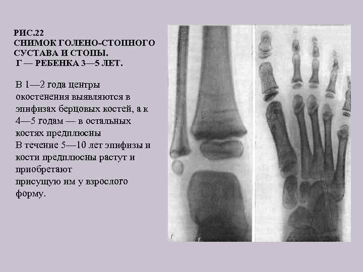 РИС. 22 СНИМОК ГОЛЕНО СТОПНОГО СУСТАВА И СТОПЫ. Г — РЕБЕНКА 3— 5 ЛЕТ.