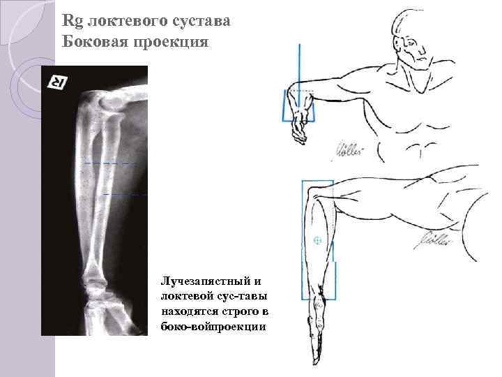 Rg локтевого сустава Боковая проекция Лучезапястный и локтевой сус тавы находятся строго в боко