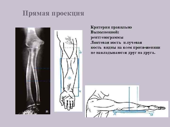 Прямая проекция Критерии правильно Выполненной: рентгенограммы Локтевая кость и лучевая кость видны на всем